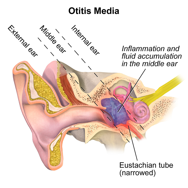 耳朵构造：婴儿的咽鼓管比成年人短；Credit