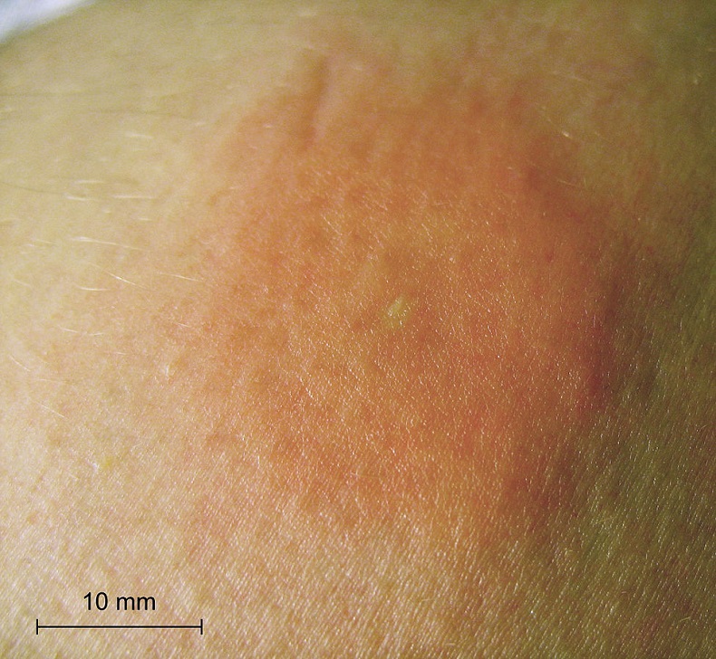 https://commons.wikimedia.org/wiki/File:Bee-sting-piqure-abeille-scale-2.jpg