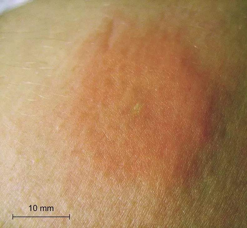 https://commons.wikimedia.org/wiki/File:Bee-sting-piqure-abeille-scale-2.jpg