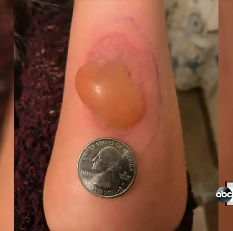 https://www.abc12.com/content/news/Saginaw-woman-treated-for-Brown-Recluse-Spider-bite-421949884.html