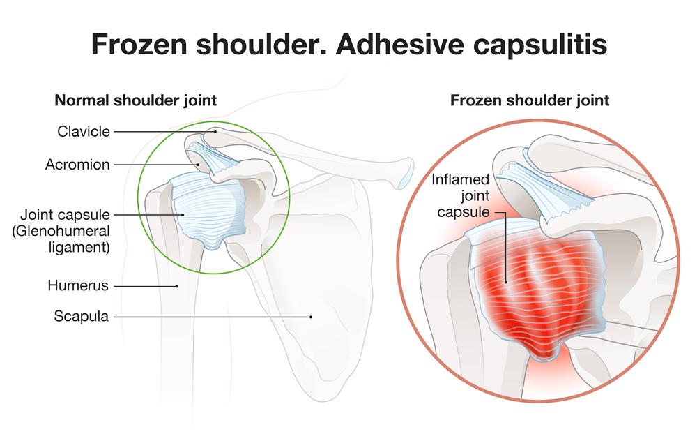 https://depositphotos.com/photo/frozen-shoulder-adhesive-capsulitis-surgery-labeled-illustration-521832086.html